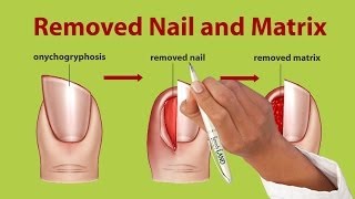 Nail Removal, Treatment for Onychogryphosis