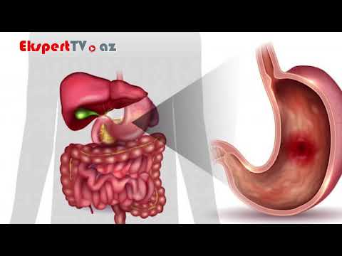 Mədə xorası nədir və əlamətləri nələrdir?