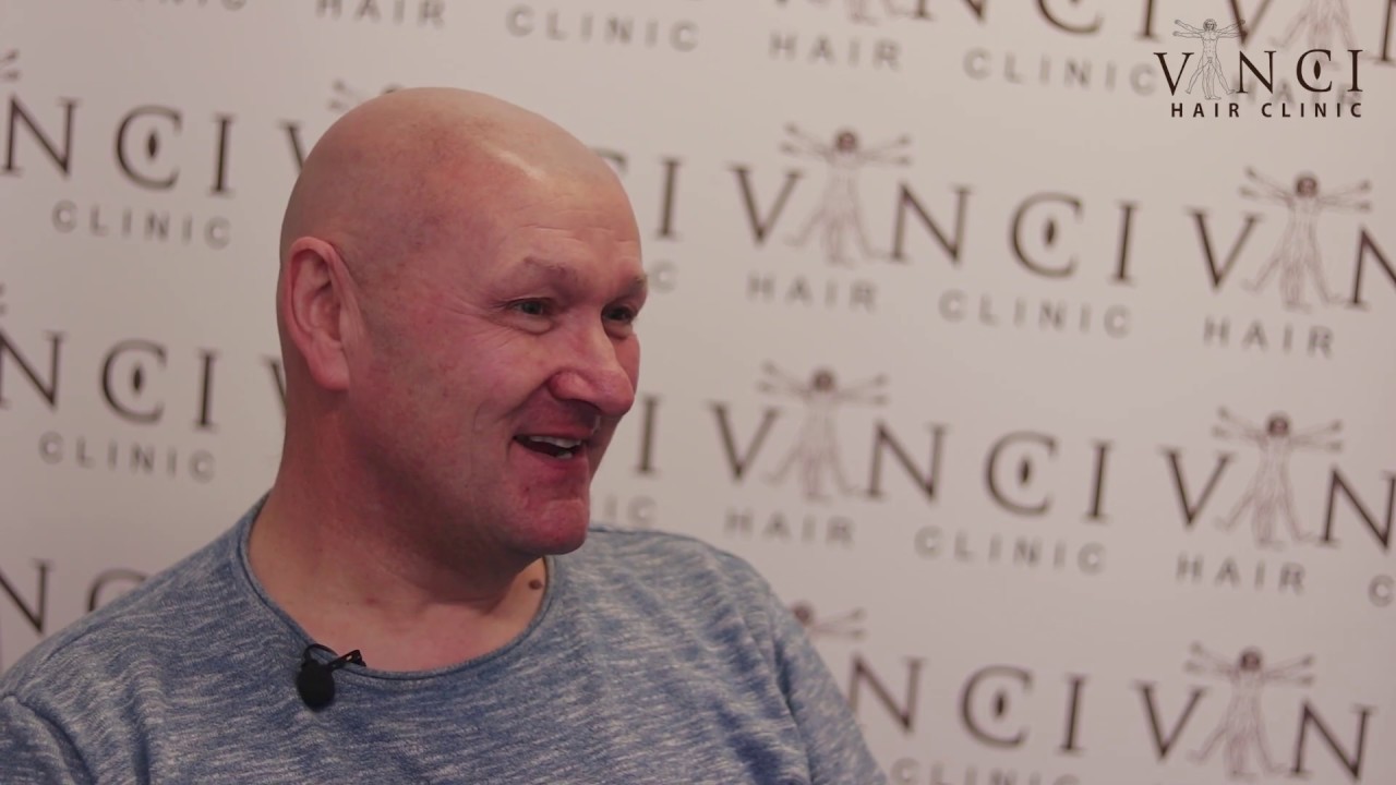 Vinci Hair Clinic Manchester Micro Scalp Pigmentation YouTube
