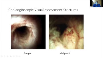 Cholangioscopy: What is this all about? - Prof. Hany Shehab
