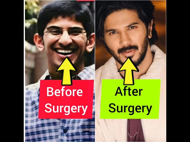 ഞെട്ടിപ്പോകും😱പ്ലാസ്റ്റിക് സർജറി ചെയ്ത് പണിപാളിയ മലയാള നടന്മാർ👄Plastic Surgery of malayalam actors👅👃 class=