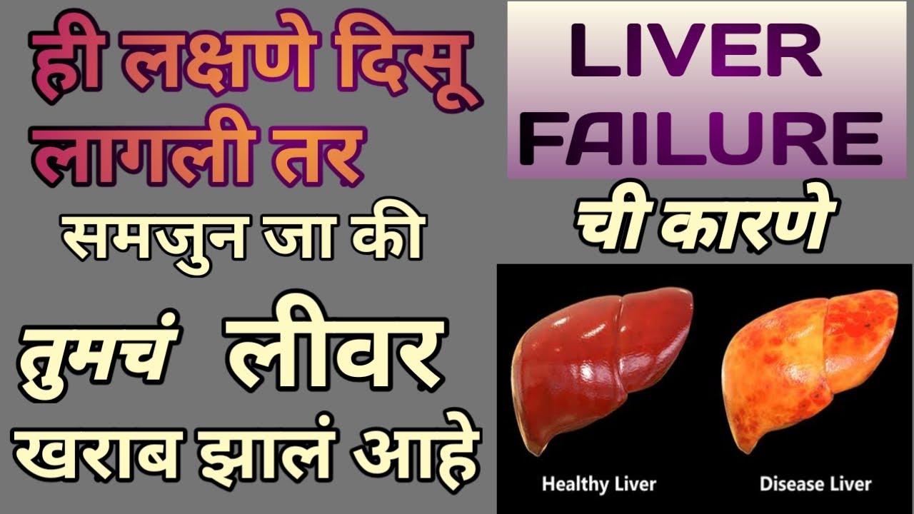 Liver Failure Symptoms In Marathi ल वर खर ब ह ण य च क रण आण लक षण Youtube