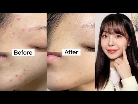 여드름 흉터는 이렇게 없애세요❗️(ft.흉터 없애는 원리와 최고의 루틴) / 여드름 없애는 법 / 피부 좋아지는 법 / 트러블 흉터 없애기 / 화농성 여드름 없애는 법 / 윤이든