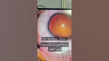 من غرفة العمليات زراعة العدسات لتصحيح قصر النظر مع دكتور أيمن نصر 