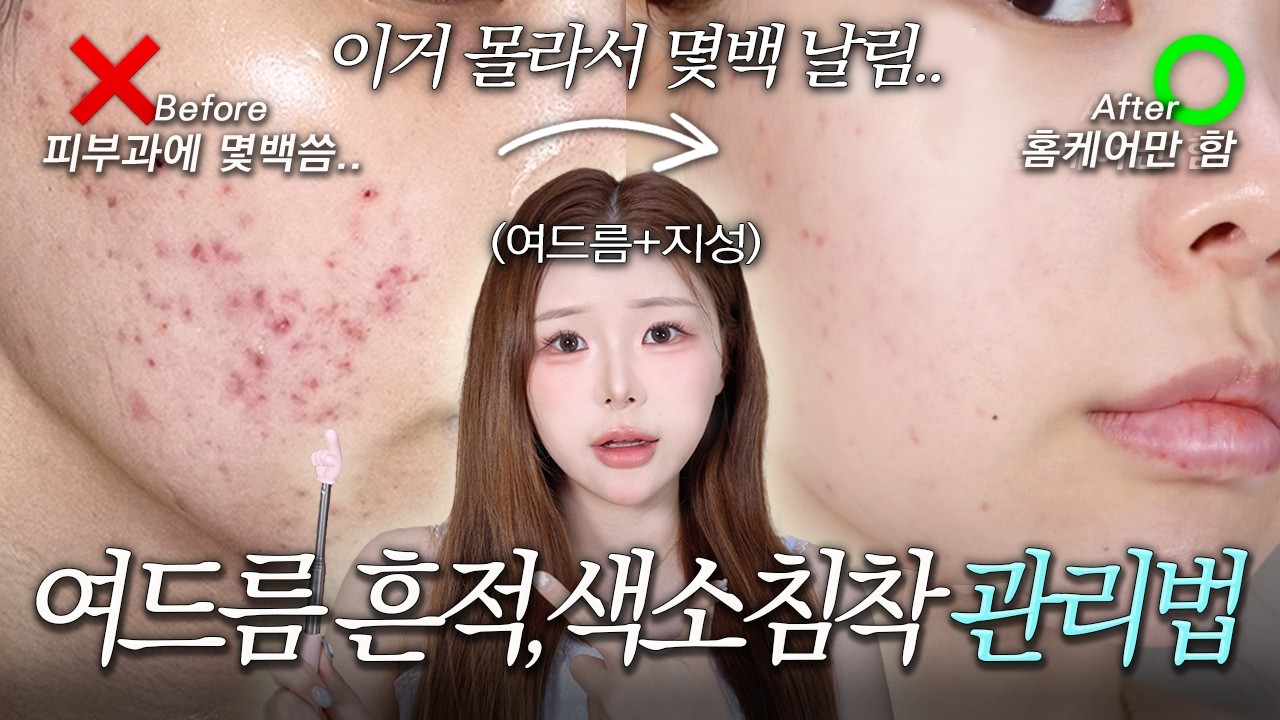 여드름 때문에 색소침착,흔적 고민인 사람 필수시청🔥10년차 여드름쟁이의 스킨케어 꿀팁‼️ | 흔적세럼 추천,스킨케어,조말랭