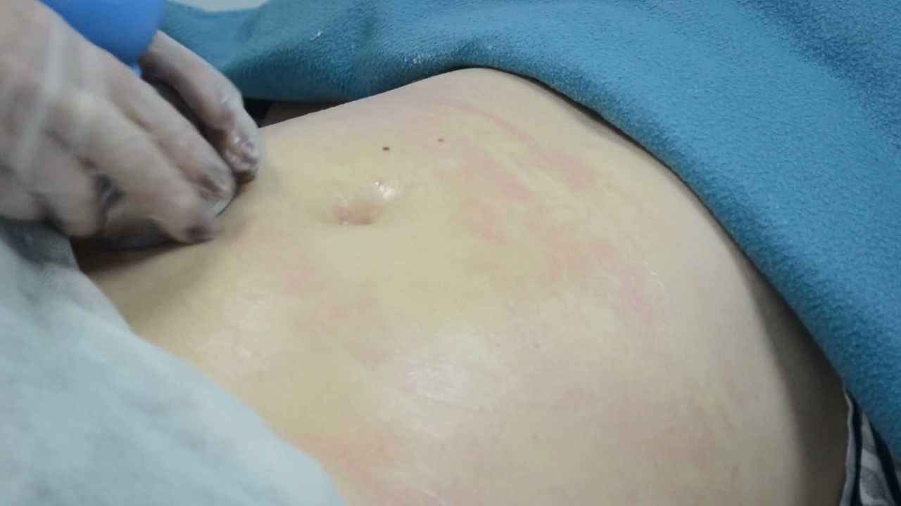 Антицеллюлитный баночный массаж 1 часть ( Valery Secret Cosmetics-Израиль.)