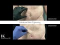 Subdermal skin tightening before and after pinch  dr hooman khorasani