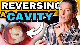 How To Reverse a Cavity at Home | Cure Tooth Decay by Dr. Ellie Phillips 2,327,617 views 5 months ago 18 minutes