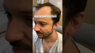 زراعة الشعر في مراكز علاجك الطبية