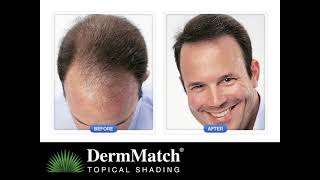 DermMatch: The Better Hair Loss Concealer For Men \& Women
