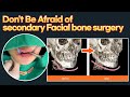 Simple and effective ‘ one-cut ’ V-line chin surgery