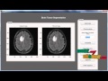 Final Year Projects 2015 | Brain Tumor Segmentation Based on Local Independent