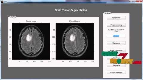 Final Year Projects 2015 | Brain Tumor Segmentation Based on Local Independent