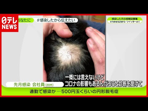後遺症か 大量の抜け毛に 代 会社員 感染したから伝えたい 新型コロナ News Zero Youtube