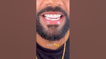 Before vs After Invisalign and composite by Dr. Josh #dentalbonding #viral