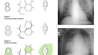 20190409 pulmonary edema and acute lung injury
