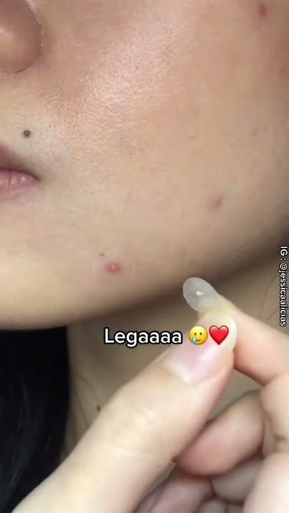 Paling satisfying nyabut acne patch 😭❤️ #skincare #acnepatch #jerawat