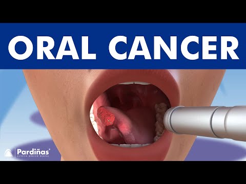 ORAL CANCER and tumors in the mouth, lips and tongue © 