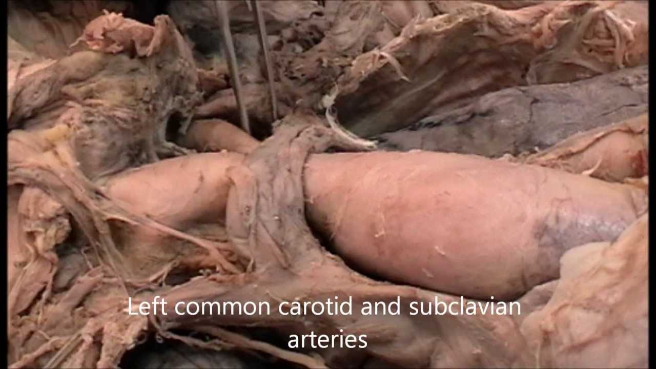 Superior mediastinum - dissection - YouTube diagram of sternum 