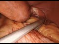 Dr ringold robotic sleeve using standard clamp