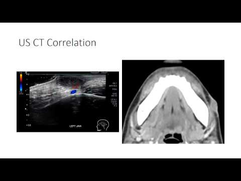 Odontogenic abscess: CT and US correlation