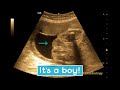 Ultrasound showing boy baby 