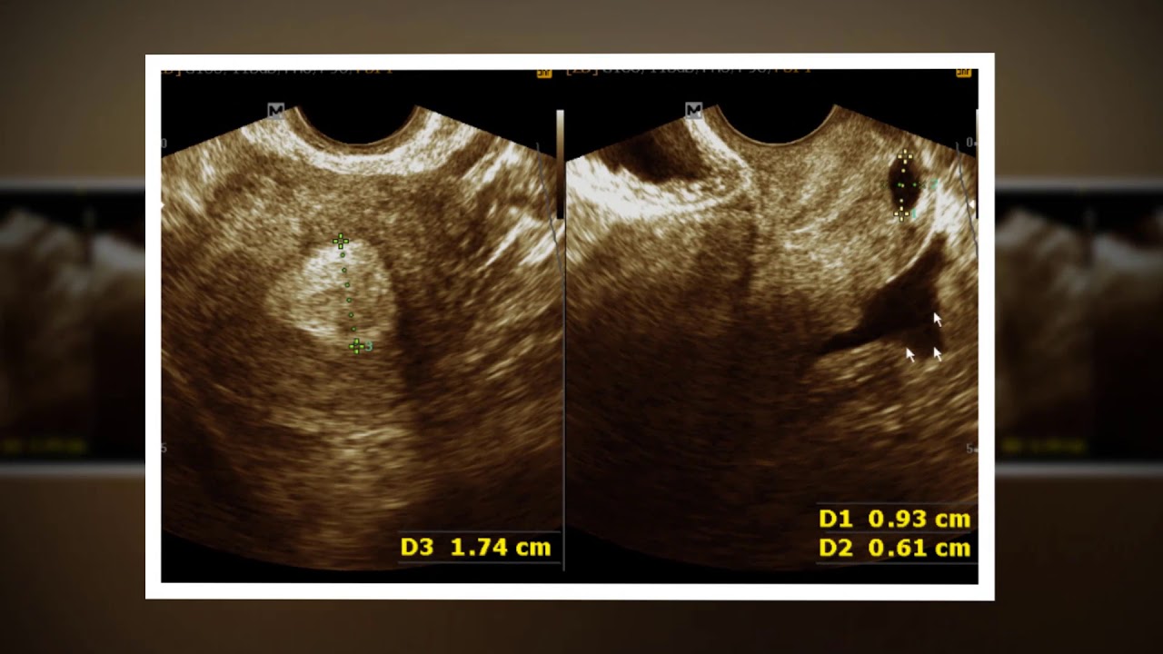 thickened-endometrium-nabothian-cyst-right-ovarian-cyst-youtube