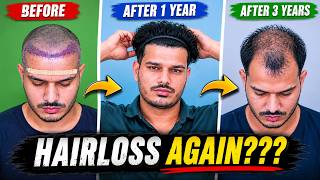 My Hair Transplant Result : Is It Really Permanent ??? Hair Transplant Result After 5 Years
