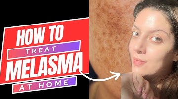 How to treat Melasma Pigmentation at home | Skincare Routine for Melasma & Hyperpigmentation