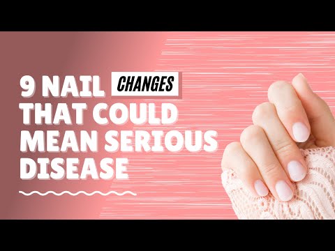 Video: Kas yra nagų liga?