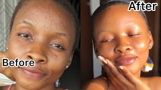 How I Truly Got Rid Of My Pimples In 2 Weeks | Clear Skin |