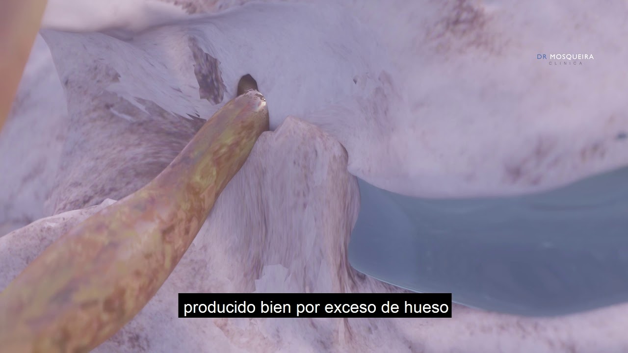 Intervención de una estenosis de canal lumbar (Animación 3D) - Clínica Dr. Mosqueira