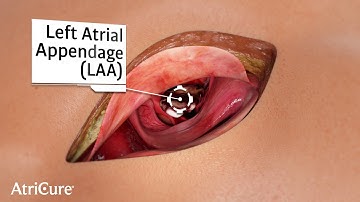 AtriClip PRO2 Animation