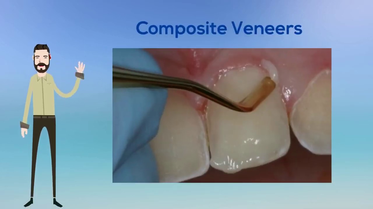 Why Composite Veneers Are Worthwhile Dental Procedures (02