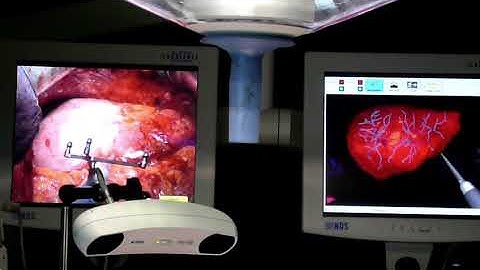 Clinical Use of the Liver Navigation System (2008)