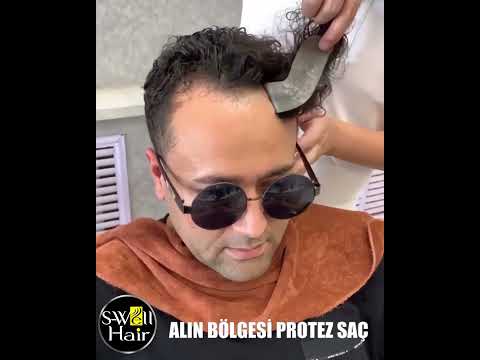 Alın Bölgesi Protez