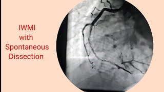 Heart attack(IWMI) with  dissection of RCA/ Stenting of RCA