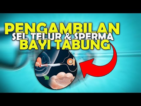 Ternyata Seperti Ini ! Proses Pengambilan Sel Telur Dan Sperma Pada Bayi Tabung