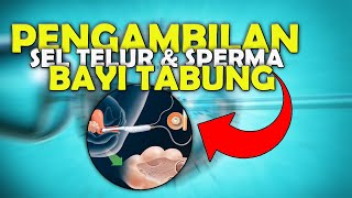 Ternyata Seperti Ini ! Proses Pengambilan Sel Telur Dan Sperma Pada Bayi Tabung