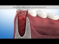 Socket and ridge preservation dental animation