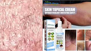 which cream is best for genital psoriasis