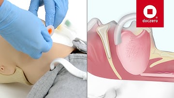 Oropharyngeal Airway inbrengen | Doczero E-learning