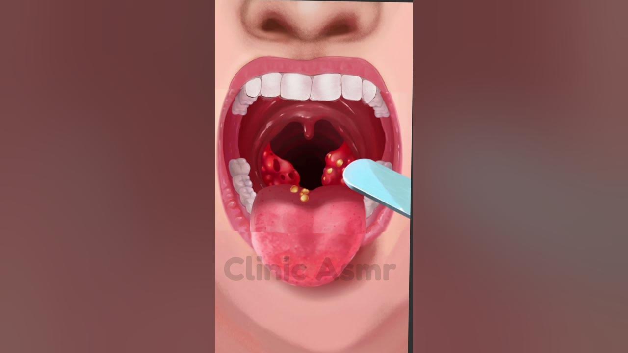 how-to-treat-tonsillitis-asmranimation-shorts-youtube