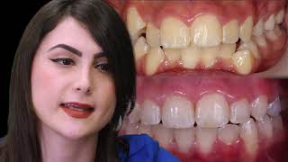 מהו יישור שיניים?