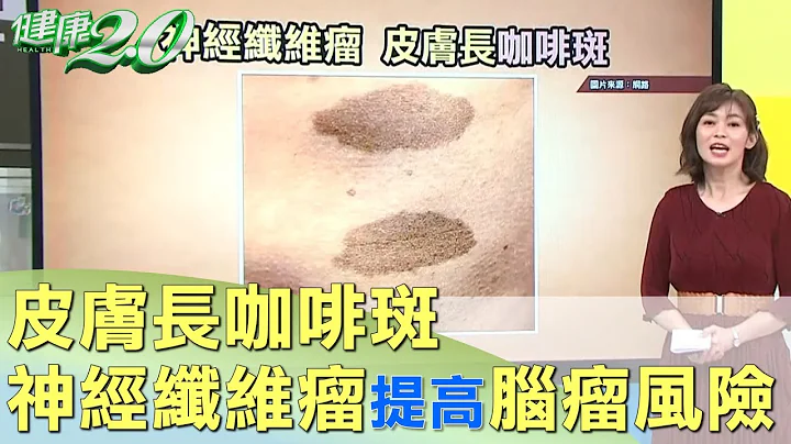 皮肤长咖啡斑 神经纤维瘤提高长脑瘤风险！ 健康2.0 - 天天要闻