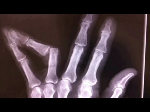 Как вправляют вывихи 16+ [How dislocations are corrected]