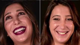 Q Dental: Testimonio Alejandra. Carillas estéticas, diseño digital de la sonrisa