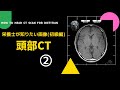 #45②【栄養士が知りたい画像(初級編)_頭部CT】How to Read  Head CT scan for Dietitian