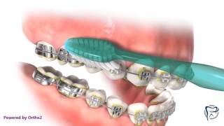 Brushing With Braces