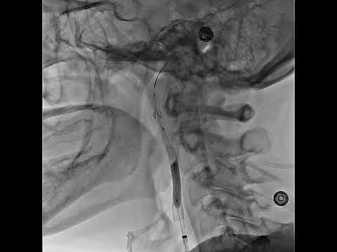 Alphenix Angiography Canon Medical Systems USA 3 